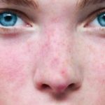 rosacea-treatment